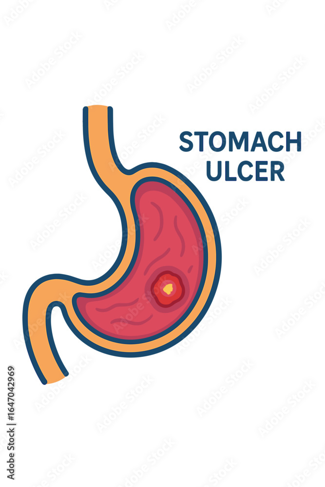 Fototapeta premium Stomach ulcer anatomy illustration with labeled parts and colors stomach ulcer diagram