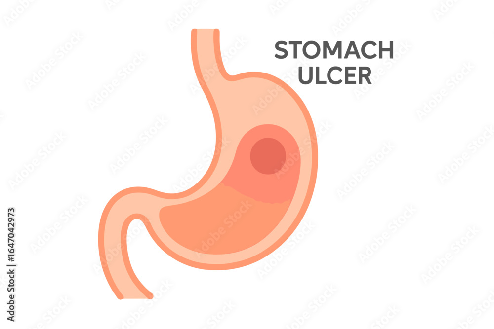 Fototapeta premium Stomach ulcer illustration showing a detailed diagram of the organ stomach ulcer diagram