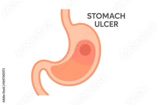 Stomach ulcer illustration showing a detailed diagram of the organ stomach ulcer diagram