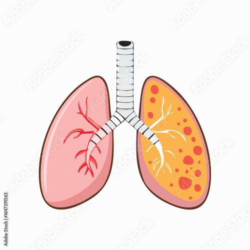 Medical illustration of human lungs, one healthy and the other showing signs of disease.