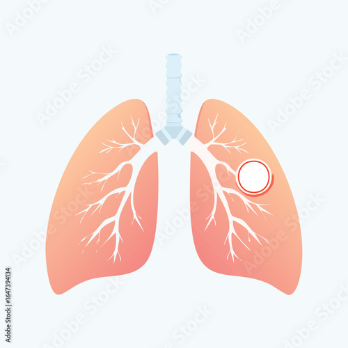 Medical illustration of human lungs, highlighting a cancerous nodule within the right lung, depicting respiratory system anatomy.