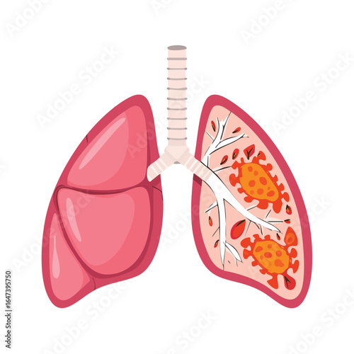 Illustration of human lungs, showing healthy lung on the left and infected lung with virus on the right.