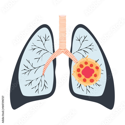 Medical illustration depicting human lungs with a cancerous tumor, highlighting disease and health concepts.