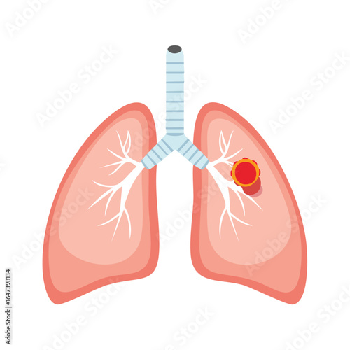 Anatomical illustration of human lungs, highlighting a cancerous tumor within the respiratory system.