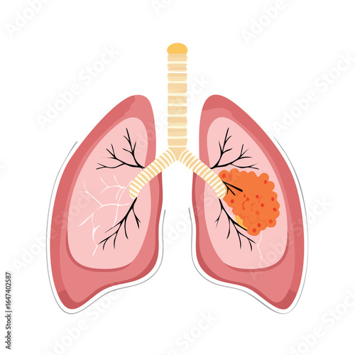 Medical illustration of human lungs with a tumor, highlighting the respiratory system's anatomy.