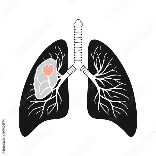Medical illustration of human lungs with a tumor, highlighting the affected area for diagnostic purposes.