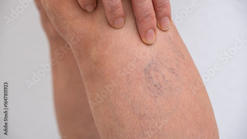 Varicose veins on women's legs. Close-ups of spider veins, dilated capillaries on a woman's shin that can be removed by sclerotherapy, reticular veins. Stage one. Phlebology.