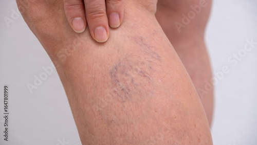 Varicose veins on women's legs. Close-ups of spider veins, dilated capillaries on a woman's shin that can be removed by sclerotherapy, reticular veins. Stage one. Phlebology.