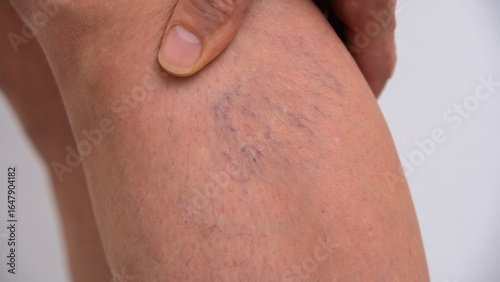 Varicose veins on women's legs. Close-ups of spider veins, dilated capillaries on a woman's shin that can be removed by sclerotherapy, reticular veins. Stage one. Phlebology.