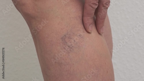 Varicose veins on women's legs. Close-ups of spider veins, dilated capillaries on a woman's shin that can be removed by sclerotherapy, reticular veins. Stage one. Phlebology.