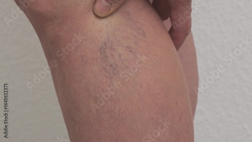 Varicose veins on women's legs. Close-ups of spider veins, dilated capillaries on a woman's shin that can be removed by sclerotherapy, reticular veins. Stage one. Phlebology.