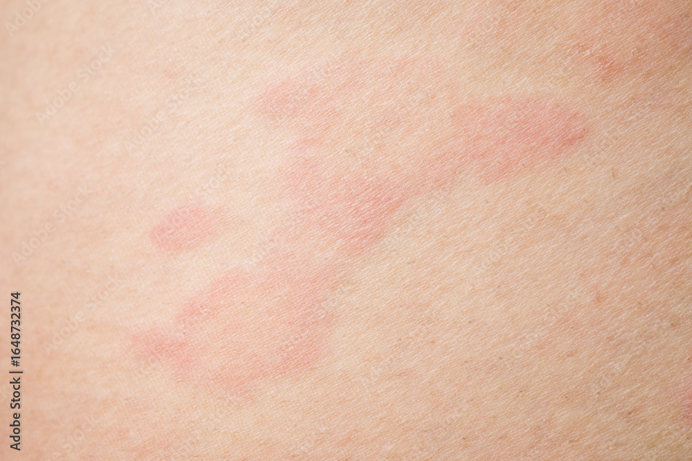 Fototapeta premium Skin allergy rash dermatitis texture close up background