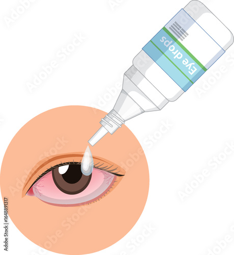 Applying Eye Drops to Red Irritated Eye Illustration