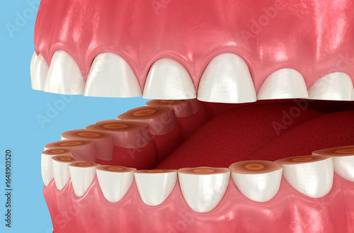 Dental attrition (Bruxism) resulting in loss of tooth tissue. Dental 3D illustration
