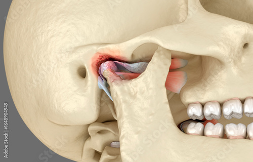 Temporomandibular joints arthritis and dislocated articular disc. Dental 3D illustration