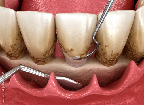 Open curettage: Scaling and root planing (conventional periodontal therapy). Dental 3D illustration