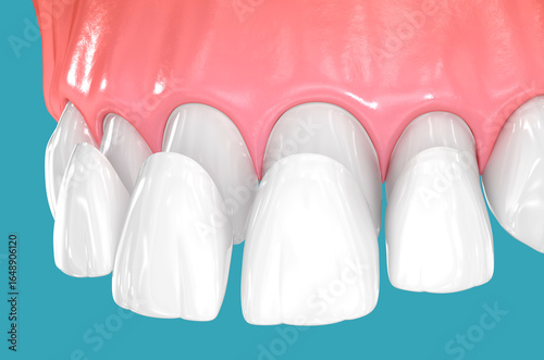 Dental veneers on blue background. 3D illustration