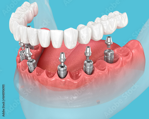 Mandibular prosthesis with gum supported by 6 implants. 3D illustration of human teeth and dentures concept