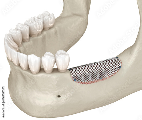 Quadro su tela Jaw bone recession and augmentation with metal membrane