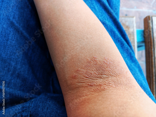 Close up of woman's elbow crease with eczema or atopic dermatitis. Itch that rashes caused by stress, soaps, dry climate. Wearing dark blue jeans and sits on wooden bench as blurred background.
