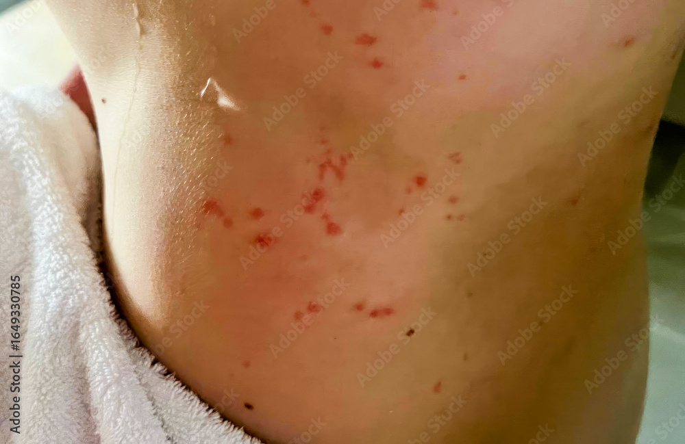 Fototapeta premium Sun-kissed skin displays celestial constellations of irritated blemishes, hinting at hidden tales of Holi skin transformations and spa escapades