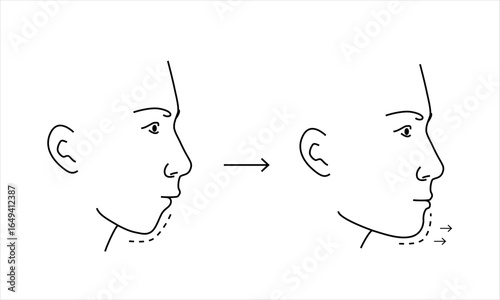 Plastic surgery of young man small chin to enlarge before and after chart. Line minimalist style drawing.