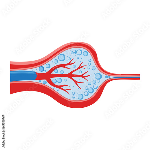 Blood Vessel with Plaque and Cholesterol Narrowing the Artery