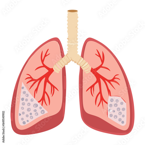 Illustration of the human lungs showing signs of a disease