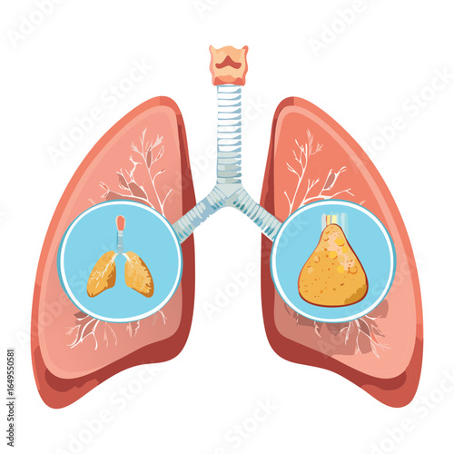 Illustration of Lungs with Disease, Showing Infected Alveoli, a Medical Visual for Respiratory Illness and Health Awareness