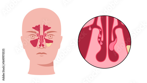 Nasal polyps poster