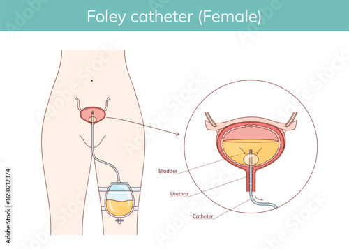 Hand drawn diagram of structure of urinary foley catheter for women. Vector Medical scientific educational illustration.