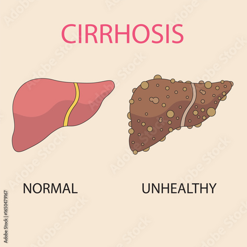 Flat vector  illustration of cirrhosis showing key symptoms like jaundice, fatigue, and swelling, with related liver diseases such as hepatitis and fatty liver highlighted.