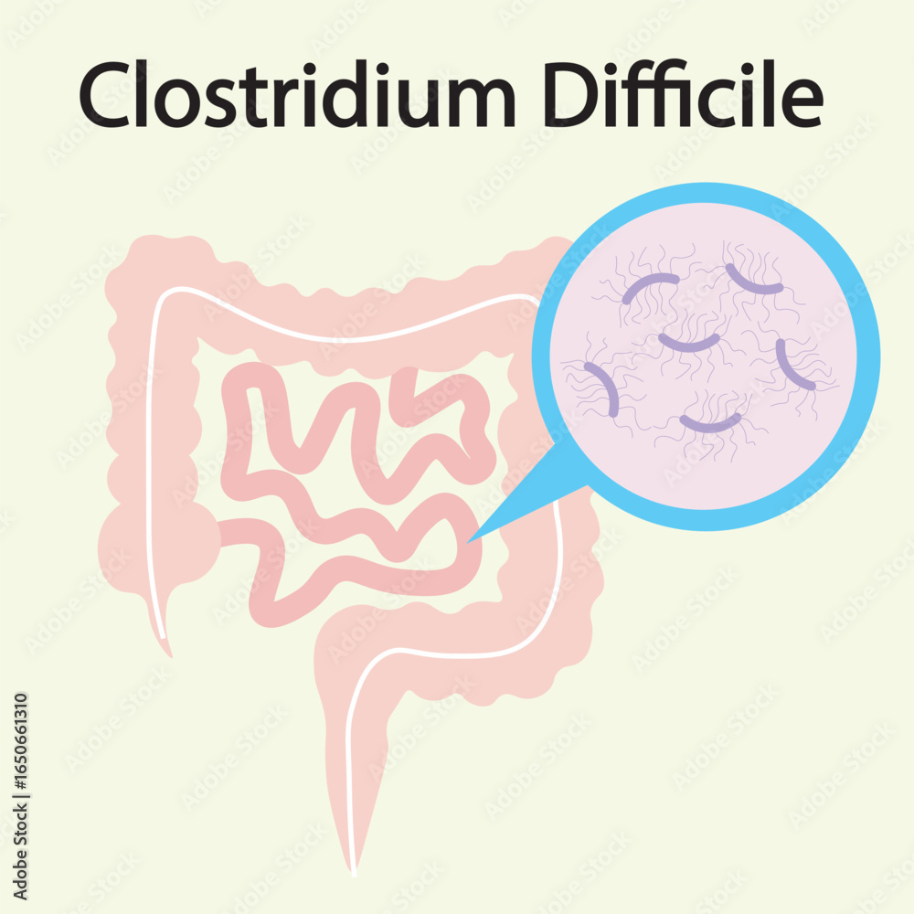 Fototapeta premium Flat vector illustration of Clostridium difficile with key symptoms like diarrhea, fever, abdominal pain, and similar diseases such as colitis and food poisoning.