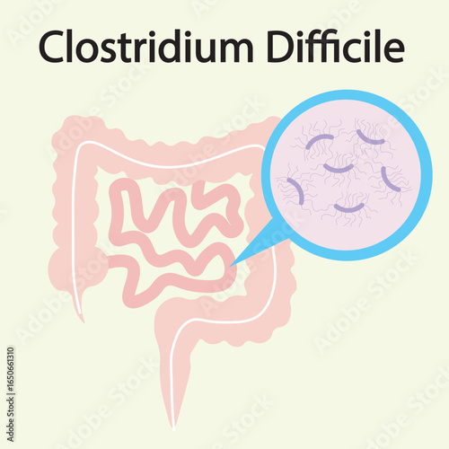 Flat vector illustration of Clostridium difficile with key symptoms like diarrhea, fever, abdominal pain, and similar diseases such as colitis and food poisoning.