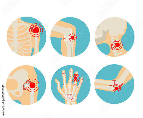 World Arthritis Day. Joints of the human skeleton with pain red dots. Rheumatoid arthritis illustration about inflammation. Arthritis body and anatomy skeleton