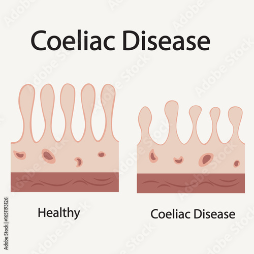 Flat vector illustration of coeliac disease showing key symptoms like bloating, diarrhea, fatigue, and highlighting related conditions such as IBS and Crohn’s disease.