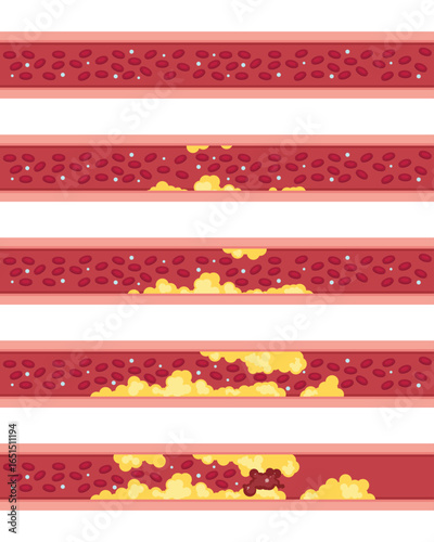 Illustration showing the progression of arterial blockage. Demonstrates the increase of plaque formation in arteries impacting blood flow over time. Visual representation of buildup.