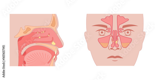 Nasal polyps poster
