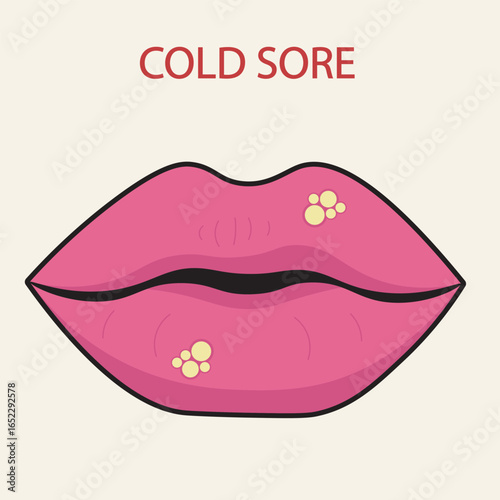 Cold sore vector illustration showing lip blisters, redness, and swelling. Includes symptoms like pain, itching, fever, and highlights similarity to canker sores and impetigo.