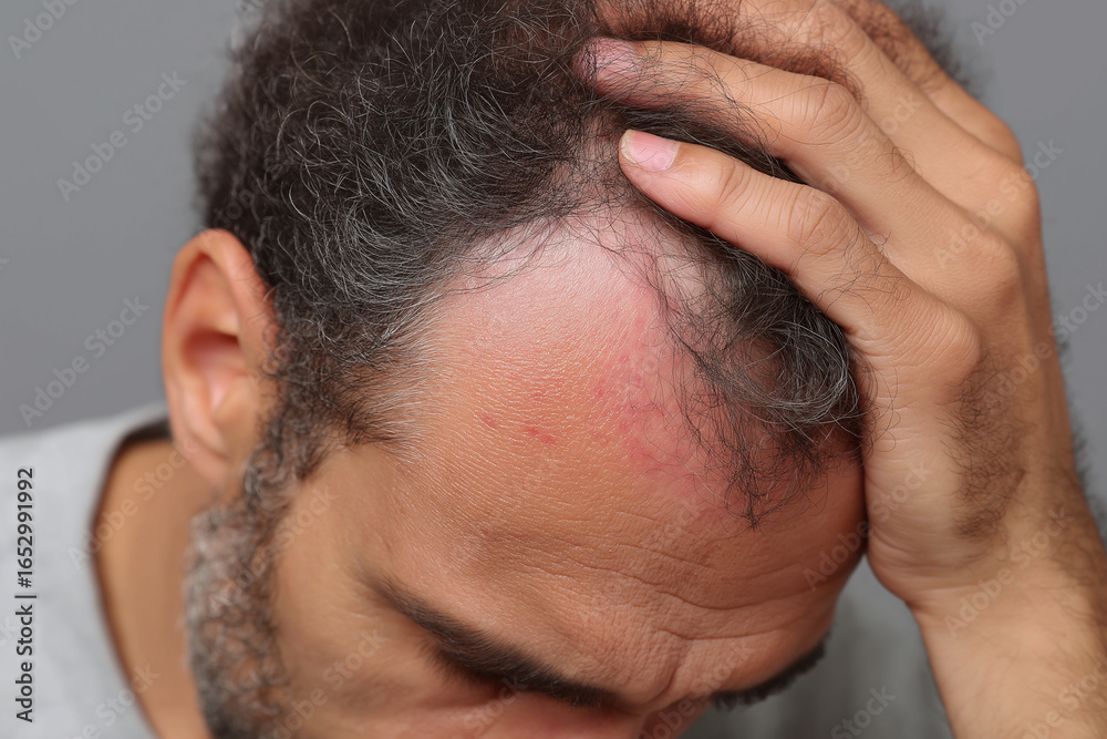 Fototapeta premium Irritated scalp redness close up man hand hairline skin condition discomfort
