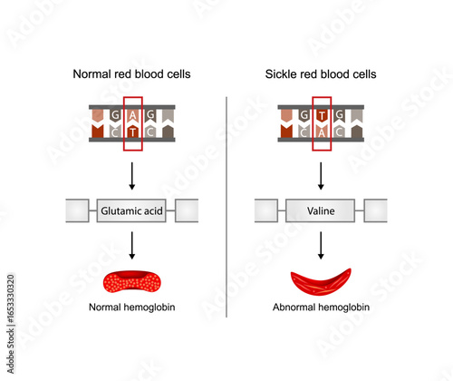 Sickle cell anemia, disease. Gene mutation. Comparison of DNA sequence between Normal red blood cell and Sickle one. Vector illustration.