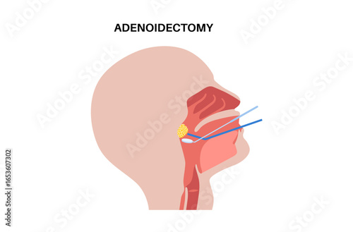Adenoidectomy medical procedure