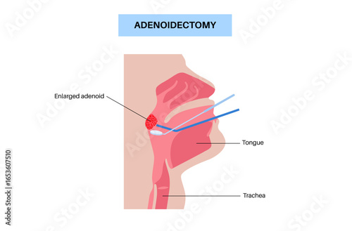 Adenoidectomy medical procedure