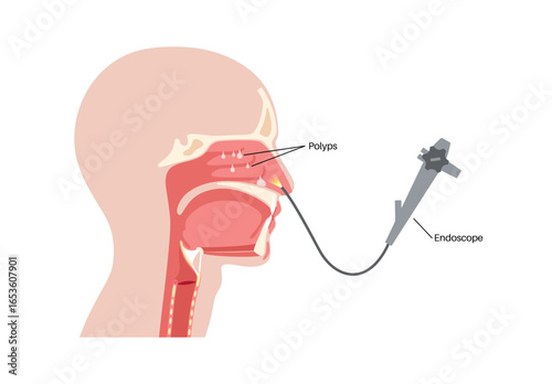 Nasal endoscopy poster