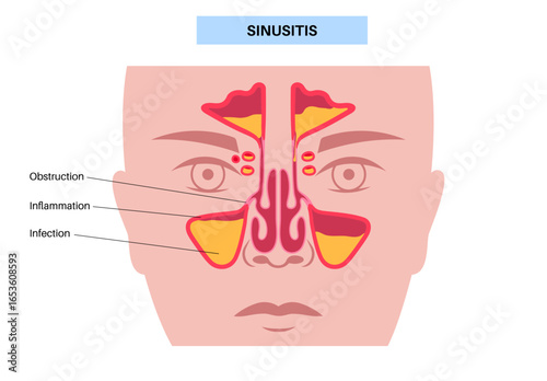 Sinusitis medical poster