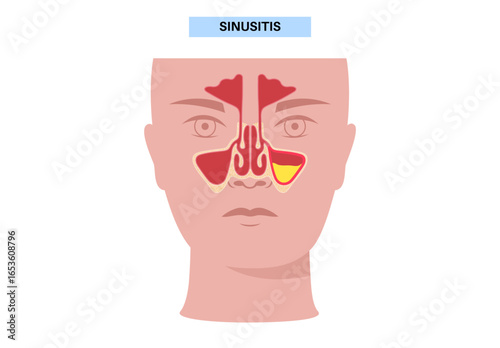 Sinusitis medical poster