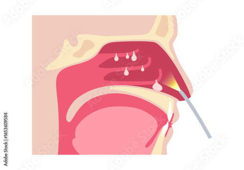 Nasal endoscopy poster