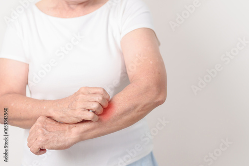 Wallpaper Mural Elderly woman itching arm and body scratching for Skin Allergy from insect bite and food dermatitis. Dermatology, Leprosy day, Systemic lupus erythematosus, Psoriasis, Urticaria and rash Eczema Torontodigital.ca