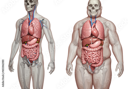 Comparative anatomical illustration showing a healthy human body versus an obese body with visible internal organs.