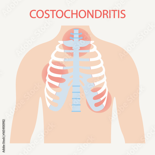 Flat vector illustration of costochondritis showing chest pain, tenderness near the sternum, swelling. Highlights similarities with heart attack and Tietze syndrome for visual comparison. icon